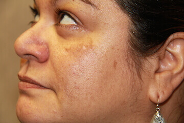 Woman 1 week after starting obagi products