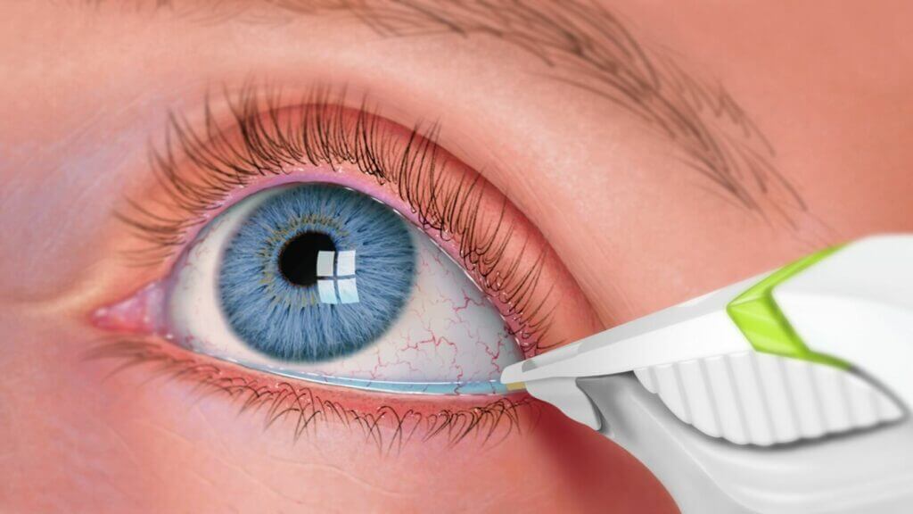 dry eye test diagram