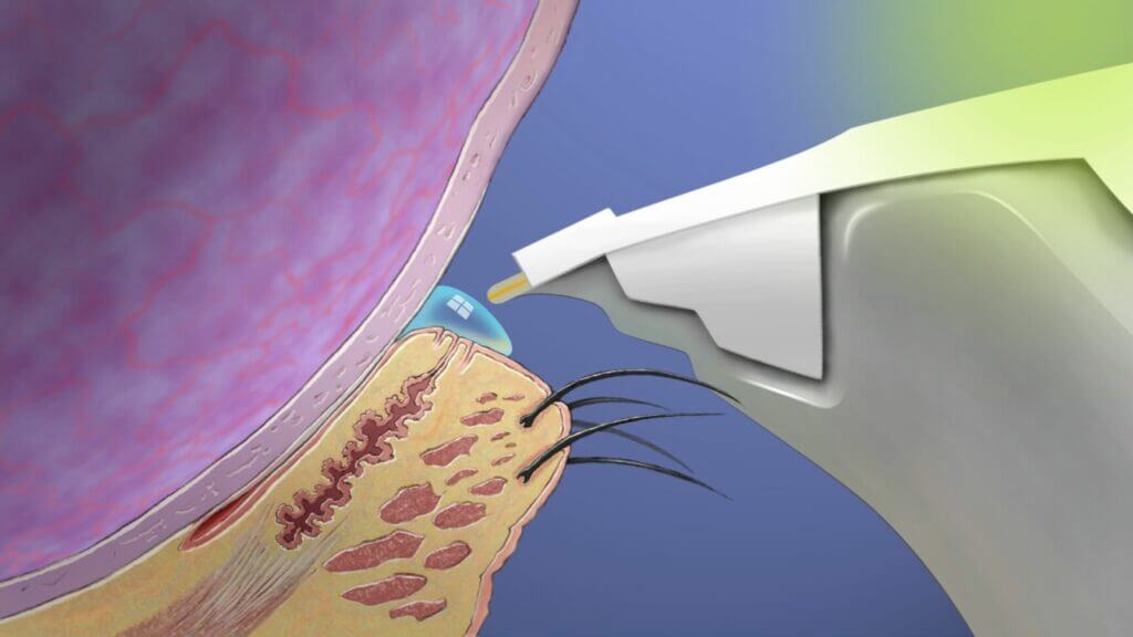 dry eye test diagram