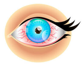 Dry Eye Illustration
