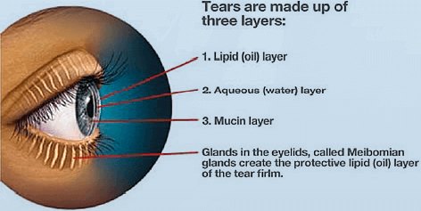 Dry eye diagram