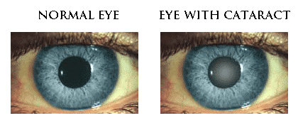 eyes with/without cataract